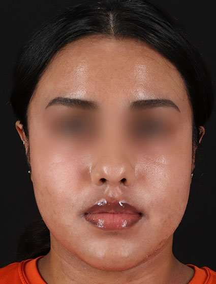Chemical Peels Before & After Patient #5621
