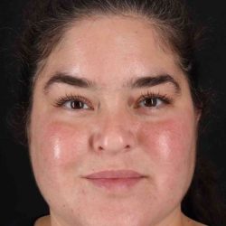 Neck Liposuction Before & After Patient #5643