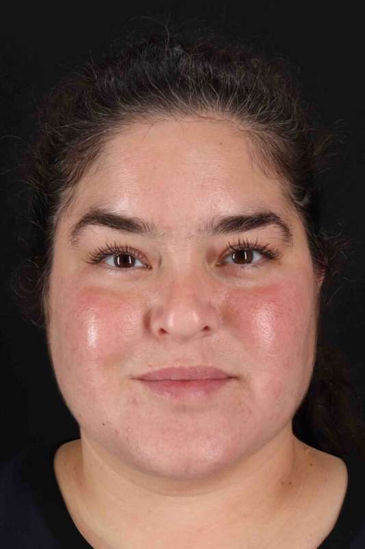 Neck Liposuction Before & After Patient #5643