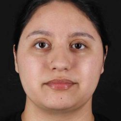Neck Liposuction Before & After Patient #5665