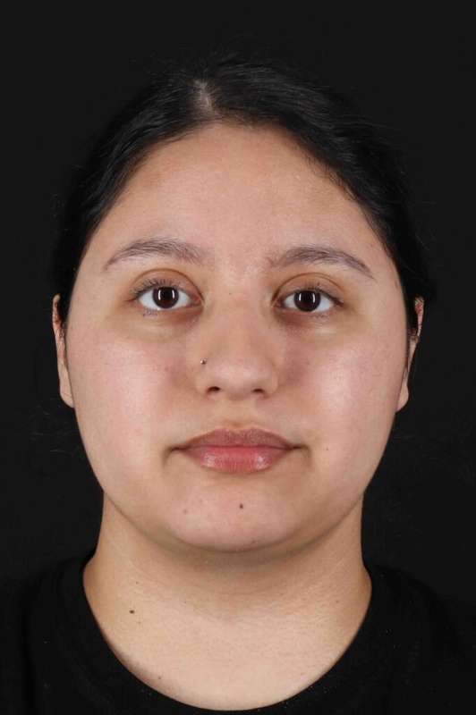 Neck Liposuction Before & After Patient #5665