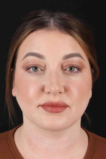 Neck Liposuction Before & After Patient #5676