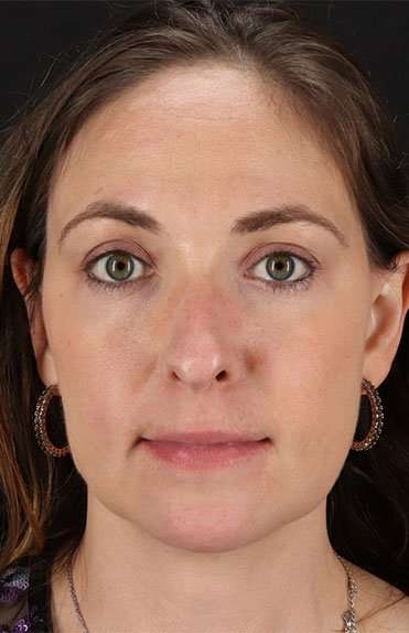 Neck Liposuction Before & After Patient #5687