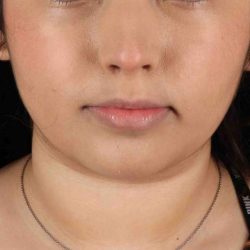 Neck Liposuction Before & After Patient #5698