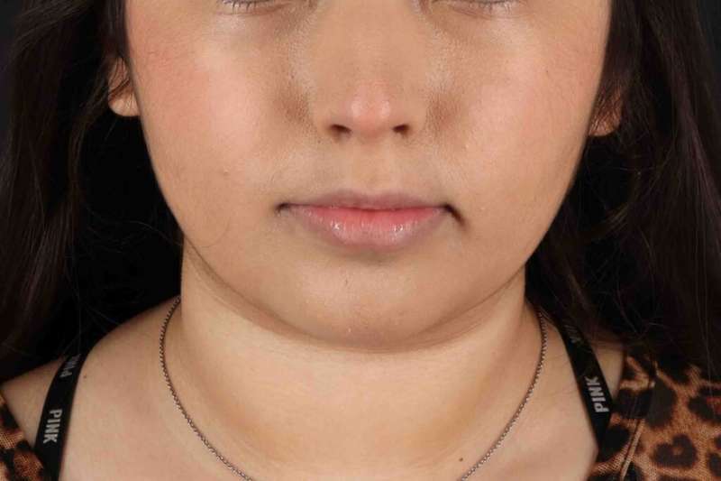 Neck Liposuction Before & After Patient #5698