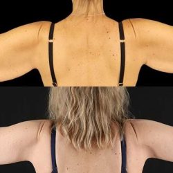 Brachioplasty (Arm Lift) Before & After Patient #1134