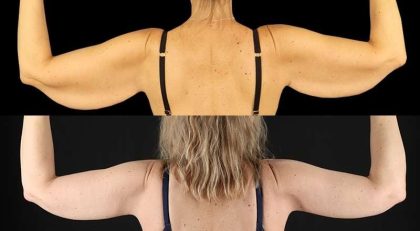 Brachioplasty (Arm Lift) Before & After Patient #1134