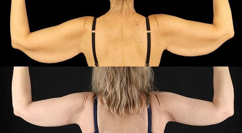 Brachioplasty (Arm Lift) Before & After Patient #1134