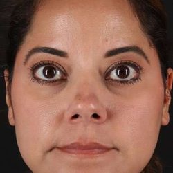 Neck Liposuction Before & After Patient #5720