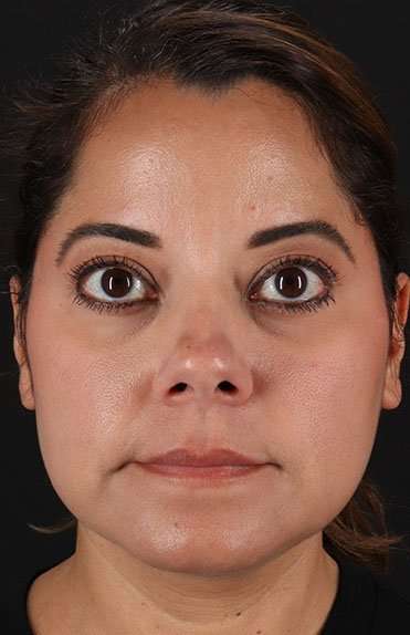Neck Liposuction Before & After Patient #5720