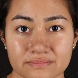 Neck Liposuction Before & After Patient #5742