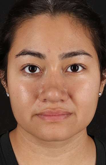 Neck Liposuction Before & After Patient #5742