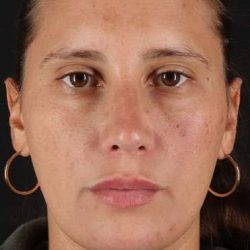 Neck Liposuction Before & After Patient #5753