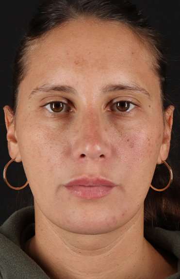 Neck Liposuction Before & After Patient #5753