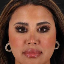 Neck Liposuction Before & After Patient #5762