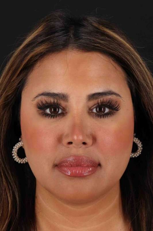 Neck Liposuction Before & After Patient #5762