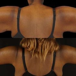 Brachioplasty (Arm Lift) Before & After Patient #1137