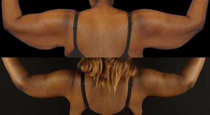 Brachioplasty (Arm Lift) Before & After Patient #1137
