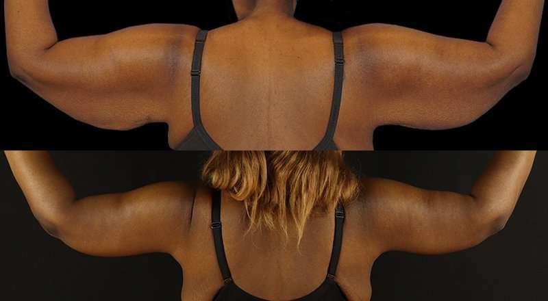 Brachioplasty (Arm Lift) Before & After Patient #1137