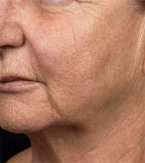 Fraxel™ Laser Before & After Patient #5801