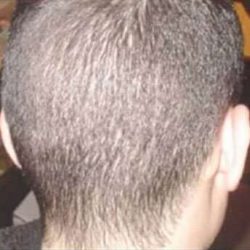 Hair Restoration Before & After Patient #5804