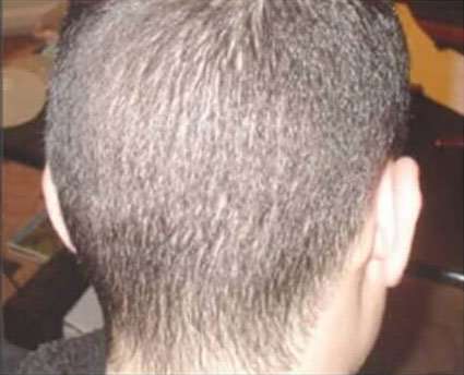 Hair Restoration Before & After Patient #5804