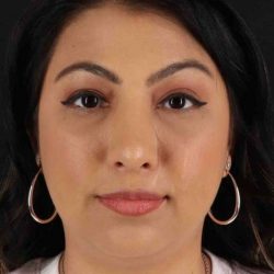 Rhinoplasty Before & After Patient #5826
