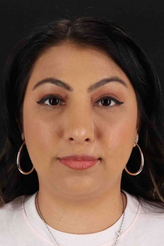 Rhinoplasty Before & After Patient #5826