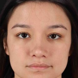 Rhinoplasty Before & After Patient #5837