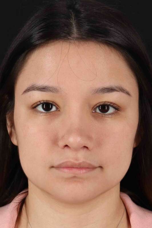 Rhinoplasty Before & After Patient #5837