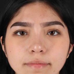 Rhinoplasty Before & After Patient #5848
