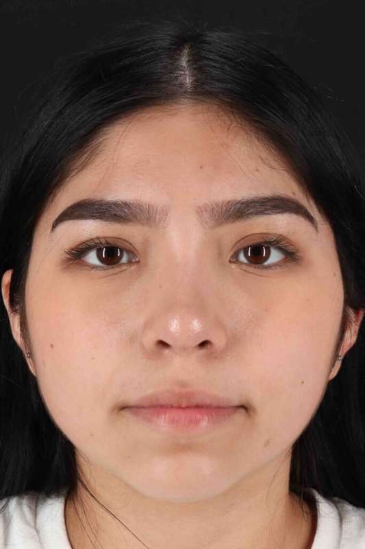Rhinoplasty Before & After Patient #5848