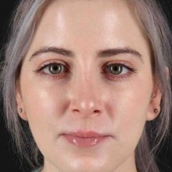 Rhinoplasty Before & After Patient #5859
