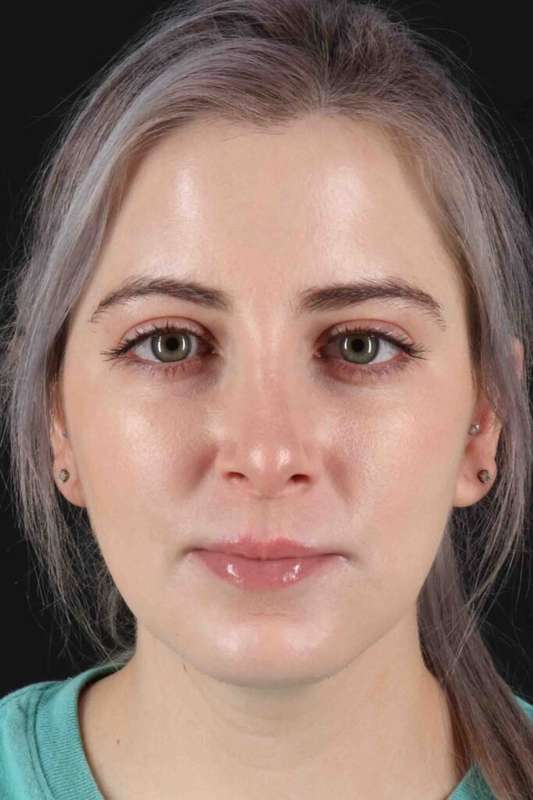 Rhinoplasty Before & After Patient #5859