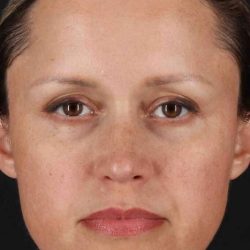 Rhinoplasty Before & After Patient #5870