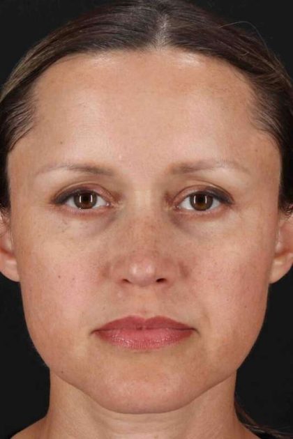 Rhinoplasty Before & After Patient #5870