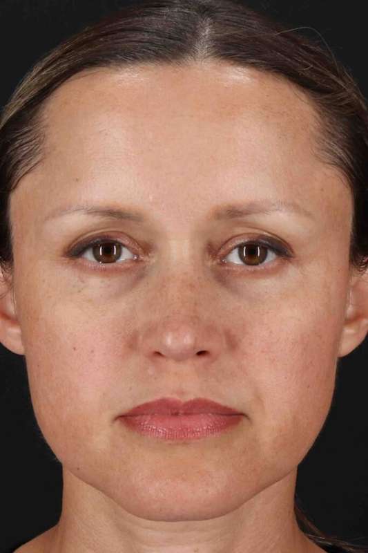 Rhinoplasty Before & After Patient #5870