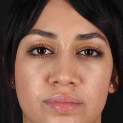 Rhinoplasty Before & After Patient #5881