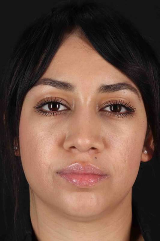 Rhinoplasty Before & After Patient #5881