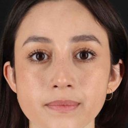 Rhinoplasty Before & After Patient #5892