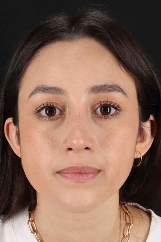 Rhinoplasty Before & After Patient #5892