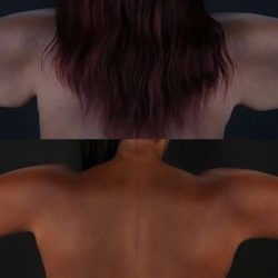 Brachioplasty (Arm Lift) Before & After Patient #1140