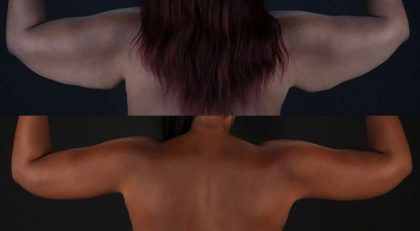 Brachioplasty (Arm Lift) Before & After Patient #1140