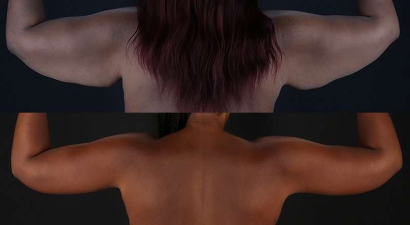 Brachioplasty (Arm Lift) Before & After Patient #1140