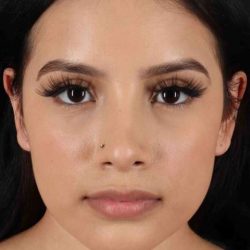 Rhinoplasty Before & After Patient #5903