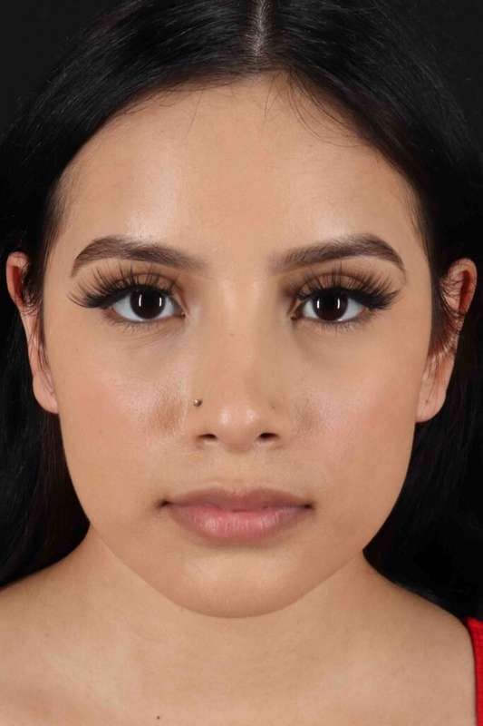 Rhinoplasty Before & After Patient #5903