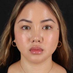 Rhinoplasty Before & After Patient #5914