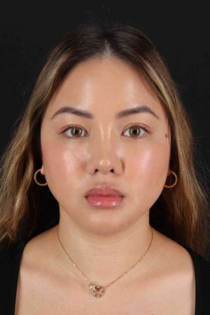 Rhinoplasty Before & After Patient #5914