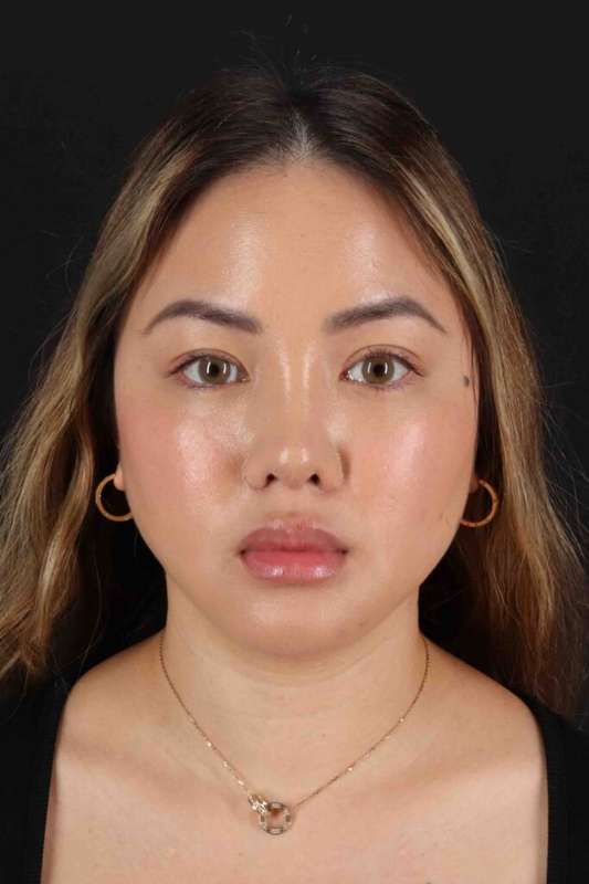 Rhinoplasty Before & After Patient #5914