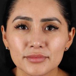Rhinoplasty Before & After Patient #5925